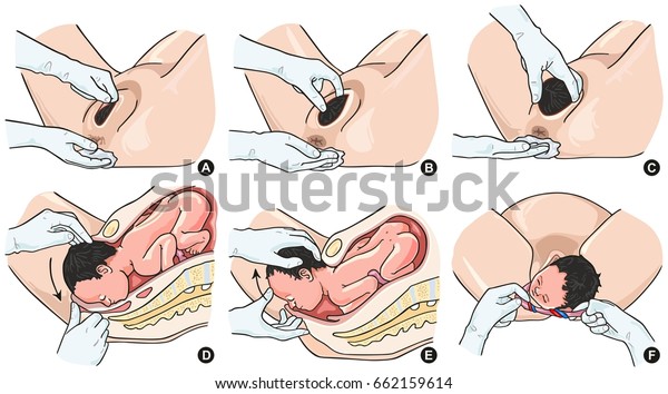 Normal\
Delivery Steps infographic diagram including all stages of labor\
and baby birth for medical science education\
