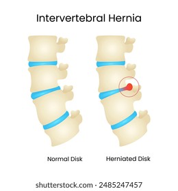 Normal Disc and Herniated Disc Intervertebral Hernia Vector