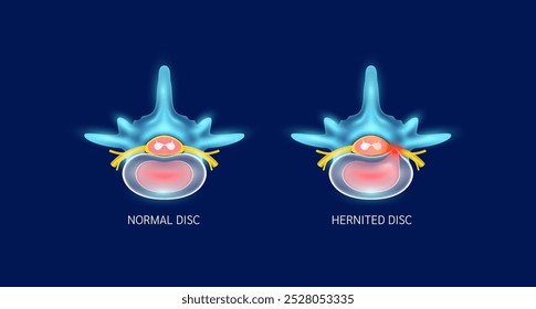 Disco normal e disco herniado que fazem dor no pescoço. Vista superior da medula espinhal amarela. Anatomia vertebral e órgão humano ósseo sobre fundo azul. Conceito de diagnóstico médico. Vetor de banner.