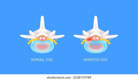 Disco normal e disco herniado que fazem dor no pescoço. Vista superior da medula espinhal amarela. Anatomia vertebral e órgão humano ósseo sobre fundo azul. Conceito de diagnóstico médico. Vetor de banner.