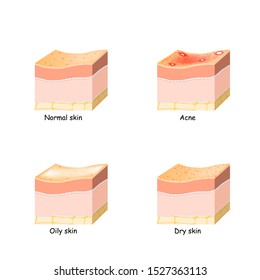 Normal, dry and oily skin. Acne. Skin disorder. Cross-section of the human skin.