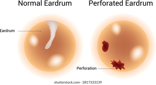Normal Eardrum and Perforated Eardrum Science Design Vector Illustration Diagram