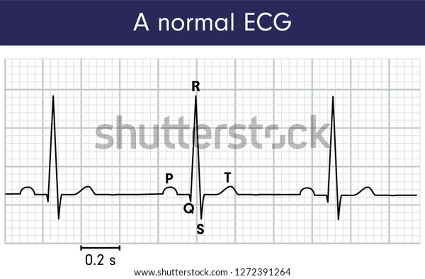 Normal Ecg Stock Vector (Royalty Free) 1272391264