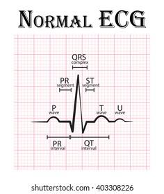 Normal ECG (Electrocardiogram) (P Wave , PR Segment , PR Interval , QRS Complex , QT Interval , ST Segment , T Wave , U Wave)