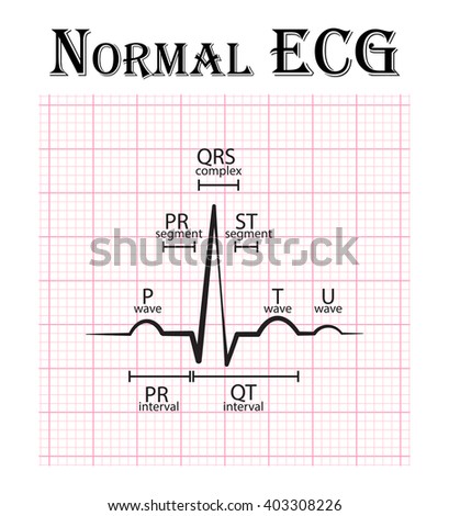 Normal ECG (Electrocardiogram) (P wave , PR segment , PR interval , QRS complex , QT interval , ST segment , T wave , U wave) [[stock_photo]] © 