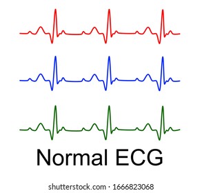 Normal ECG Vector Analysis Wave