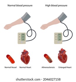 Normal Enlarged Heart Cardiomegaly Atherosclerosis Hand Stock Vector ...