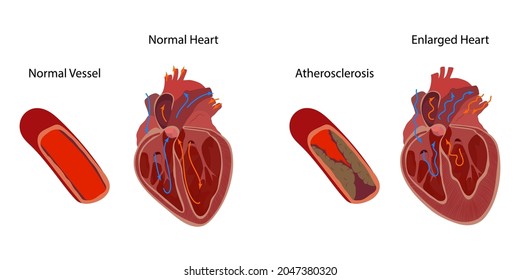 Normal Enlarged Heart Cardiomegaly Atherosclerosis Direction Stock Vector Royalty Free
