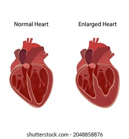 Normal Enlarged Heart Cardiomegaly Inner Inside Stock Vector (royalty 