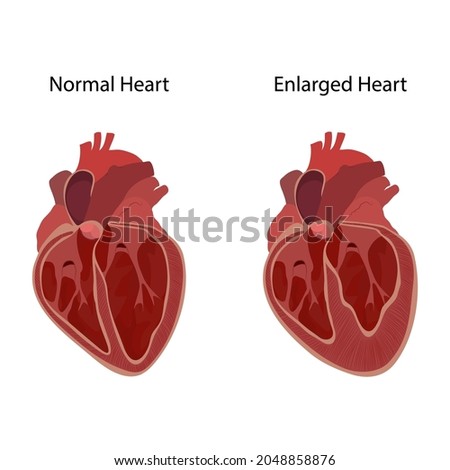 Normal and enlarged heart, cardiomegaly, inner inside view. Vector anatomy flat medical illustration.