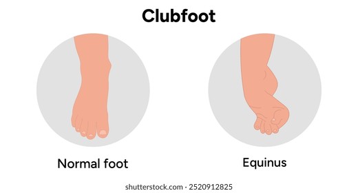 Normal e Equinus Clubfoot problema pé. Diagrama infográfico ortopédico