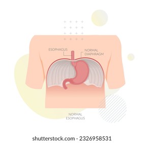 Esófago normal - Músculo grande entre el abdomen y el diafragma - Ilustración como archivo EPS 10