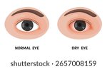 Normal eye and dry eye, irritated eye, redness, conjunctivitis