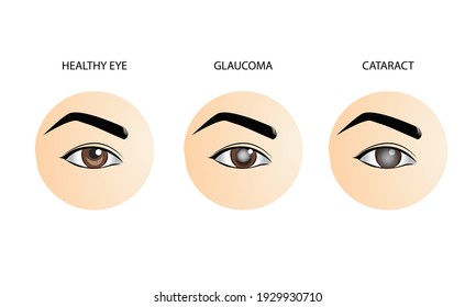 Normale Augen, Glaukom und Katarakt, medizinische Vektorgrafik