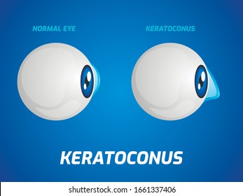 Normal eye and keratoconus concept. Vector illustration.