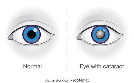 Normal eye and lens clouded by cataract. Illustration about eyesight.