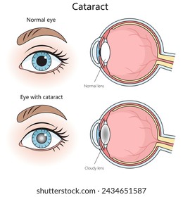 normal eye and one with a cataract, showing clear and cloudy lenses respectively structure diagram hand drawn schematic vector illustration. Medical science educational illustration