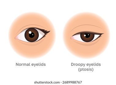 Pálpebras Normais vs. Pálpebras Droopy: Uma Ilustração Simples De Ptose. A imagem pode ser usada para beleza e conteúdo médico.