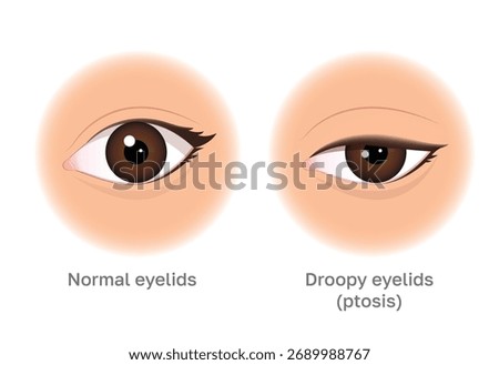 Normal Eyelids vs. Droopy Eyelids: A Simple Ptosis Illustration. Image can be used for beauty and medical content.