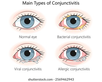 normal eyes, bacterial, viral, and allergic conjunctivitis, symptoms redness, discharge, and irritation diagram hand drawn schematic vector illustration. Medical science educational illustration