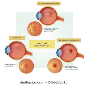 Normal Eyes vs Dry - Wet Macular Degeneration - Stock Illustration as EPS 10 File