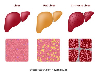 11,070 Fatty Liver Images, Stock Photos & Vectors 