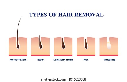 Normal follicle and types of hair removal with help of razor, depilation cream, wax, sugaring vector illustration