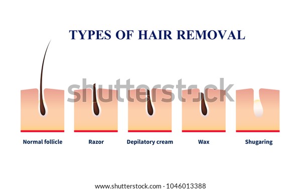 Normal Follicle Types Hair Removal Help Stock Vector Royalty Free