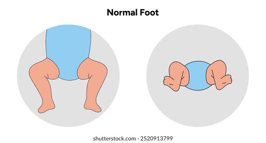 Pé normal em crianças. Diagrama infográfico ortopédico