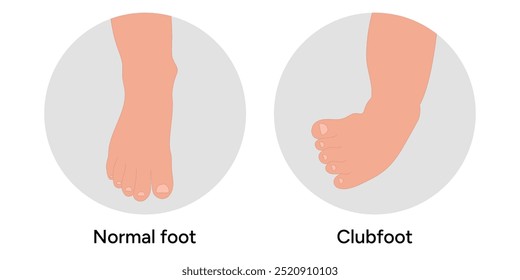 Normal foot and Clubfoot problem foot. Orthopedic infographic diagram