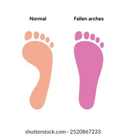 Normal foot and fallen arches	