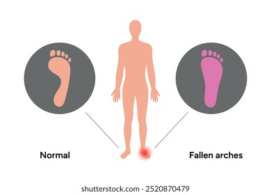 Normal foot and fallen arches foot. Orthopedist diagram