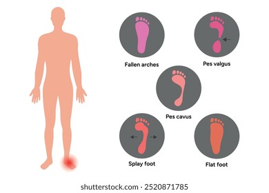 Pé normal e arcos caídos, pes valgus, pes cavus, pé liso e pé de guincho. Diagrama ortopédico