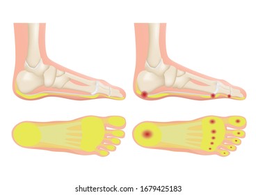 normal foot and a foot with a fat pad atrophy / callus