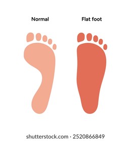 Normal foot and flat foot	