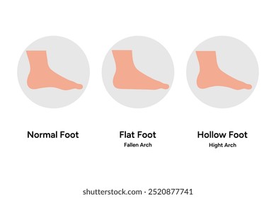 Normal foot, flat and hollow foot and footprint. Fallen and hight arch. Orthopedist diagram infographic