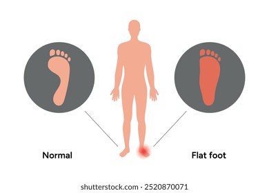 Normal foot and flat foot. Orthopedist diagram