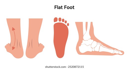 Normal foot and flat foot. Orthopedist diagram infographic