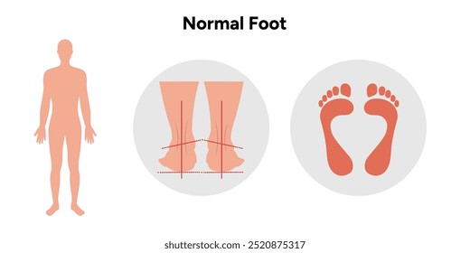 Normal foot and footprint. Orthopedist diagram infographic