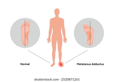 Normal foot and metatarsus adductus foot. Orthopedist diagram