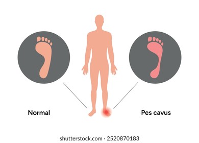 Normal foot and pes cavus foot. Orthopedist diagram