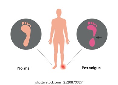 Normal foot and pes valgus foot. Orthopedist diagram