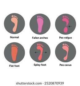 Pé normal e pé splay, arcos caídos, pes valgus, plana, pé pes cavus. Diagrama ortopédico