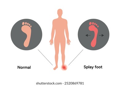 Normal foot and splay foot. Orthopedist diagram