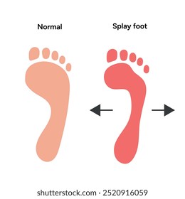 Normal foot and splay foot printfoot