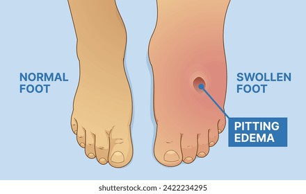 Normal foot, swollen foot. Before, after. Pitting edema.  Vector illustration. 