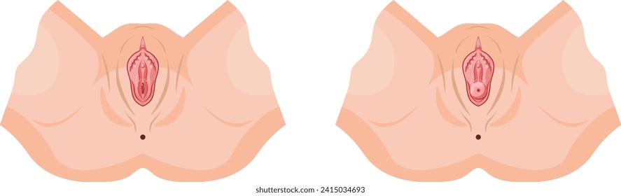 normal genital compared to genital with uterine prolapse