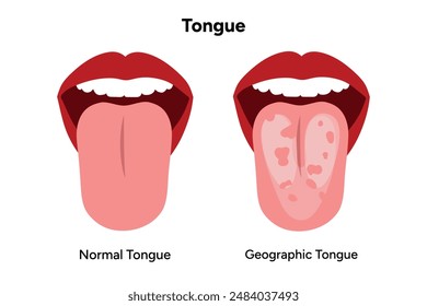 Normal and geographic tongue problem