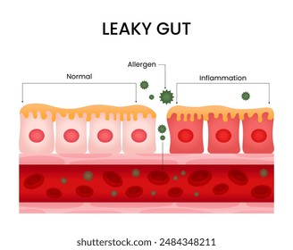 Normal Gut and Leaky Gut Vector