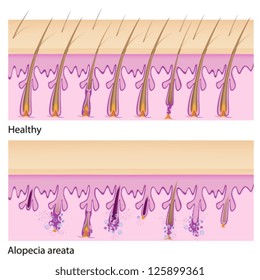 Normal hair and Alopecia areata